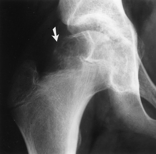 Malignant Bone And Soft Tissue Tumors Radiology Key