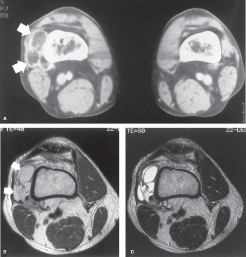 Malignant Bone And Soft Tissue Tumors Radiology Key