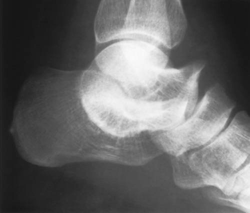 Skeletal Trauma | Radiology Key