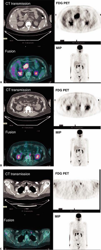 PET And PET/CT Of Malignant Melanoma | Radiology Key