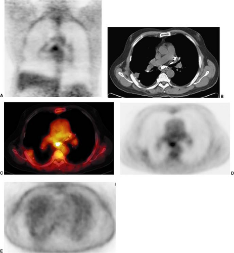 Use of PET and PET/CT in the Evaluation of Patients with Head and Neck ...