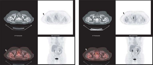 Thyroid Cancer And Thyroid Imaging Radiology Key