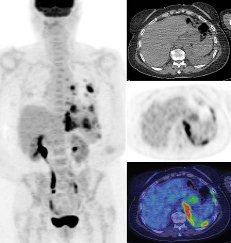 Lung Cancer Radiology Key 1030