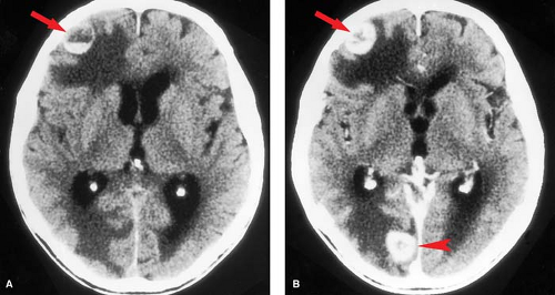 Cerebrovascular Disease Radiology Key