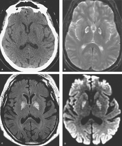 White Matter and Neurodegenerative Diseases | Radiology Key