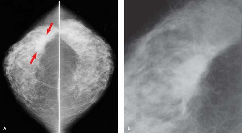súlycsökkenés és rendellenes mammogram fogyni szafival