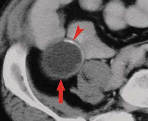 Colon and Appendix | Radiology Key