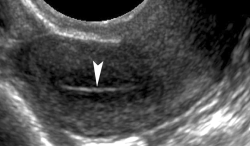 Эндометрия 3 мм. УЗИ картина полипа эндометрия. Ретроцервикальный эндометриоз на УЗИ.