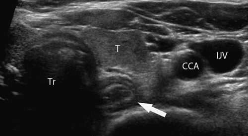 Chest, Thyroid, Parathyroid, and Neonatal Brain Ultrasound | Radiology Key