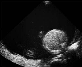 Amniotic Fluid | Radiology Key