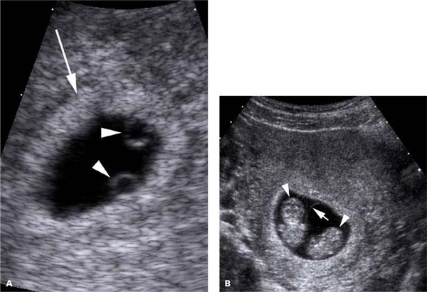 7 week ultrasound identical twins