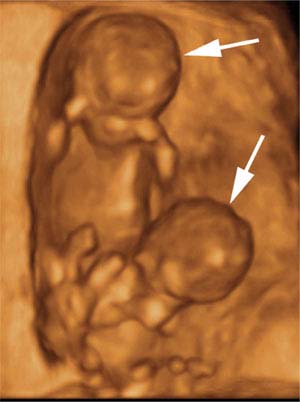 8 week ultrasound 3d twins