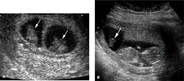 fraternal twins in the womb at 10 weeks