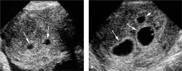 diagnosis-and-characterization-of-multiple-gestations-radiology-key