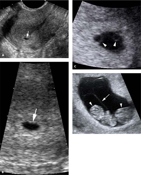 7 week ultrasound identical twins