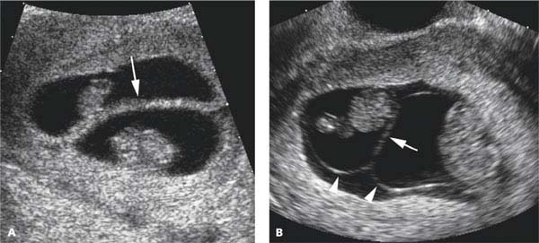 Diagnosis And Characterization Of Multiple Gestations Radiology Key