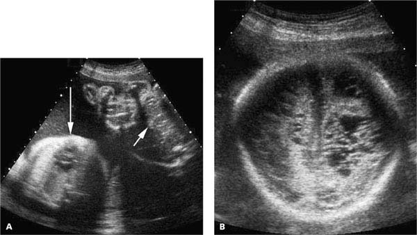 Complications Of Multiple Gestations | Radiology Key