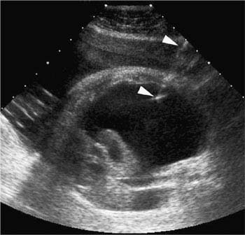 fetal pleural effusion ultrasound