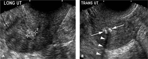 Endometrium | Radiology Key