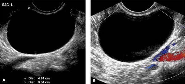 Ovaries And Adnexa Radiology Key