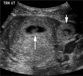 Ectopic Pregnancy | Radiology Key