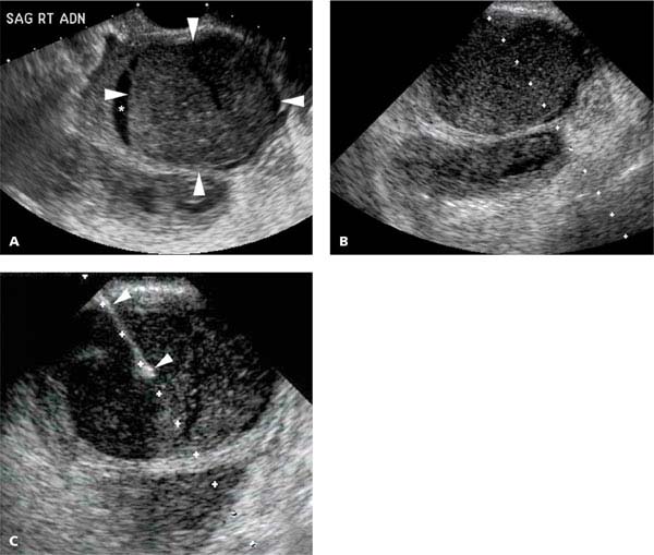 Uterus | Radiology Key