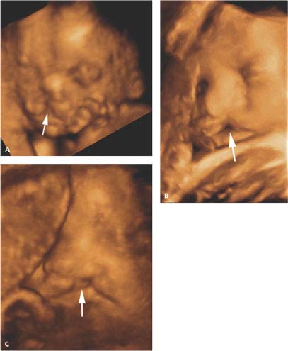 cleft lip 3d ultrasound