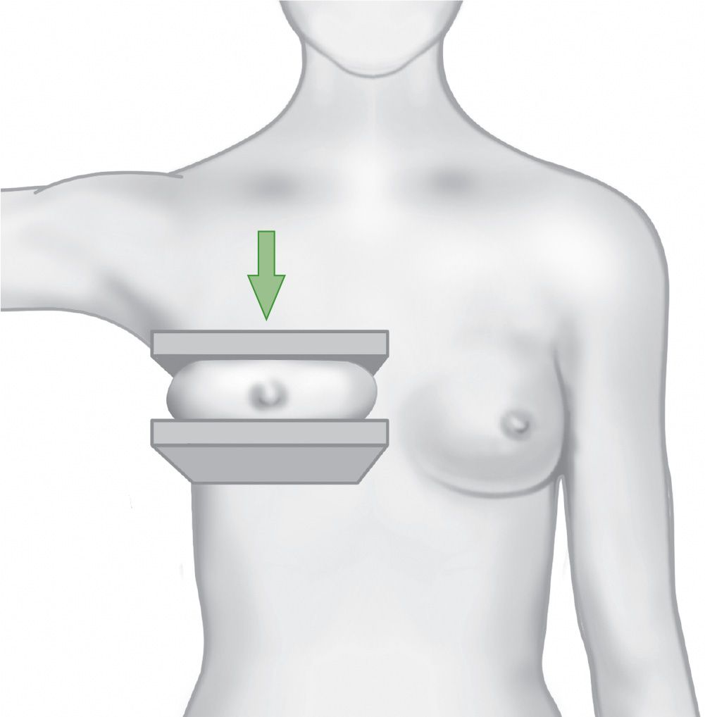 Projection proportion. E: most inferior point of the breast from the