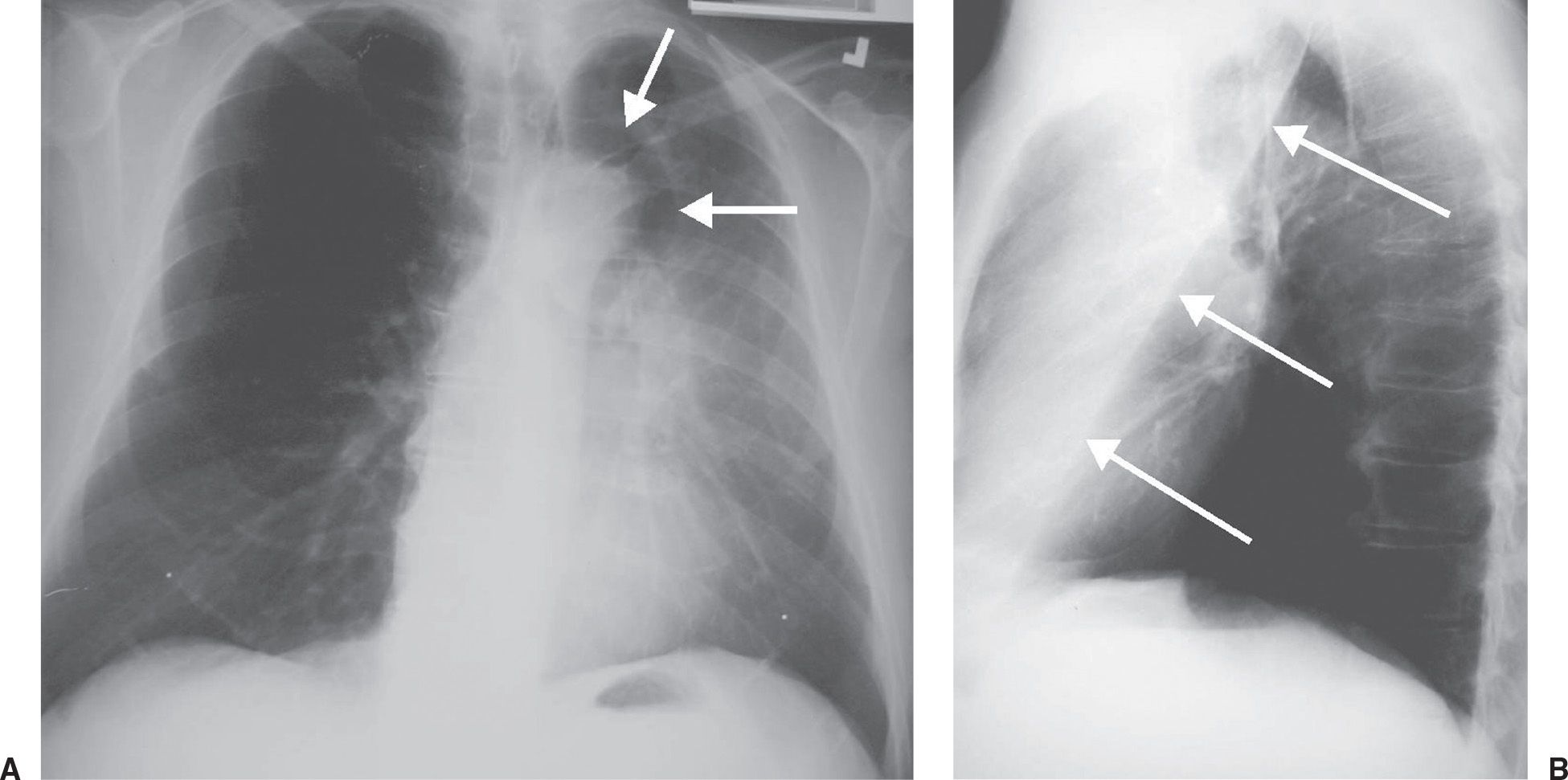 Signs in Thoracic Imaging