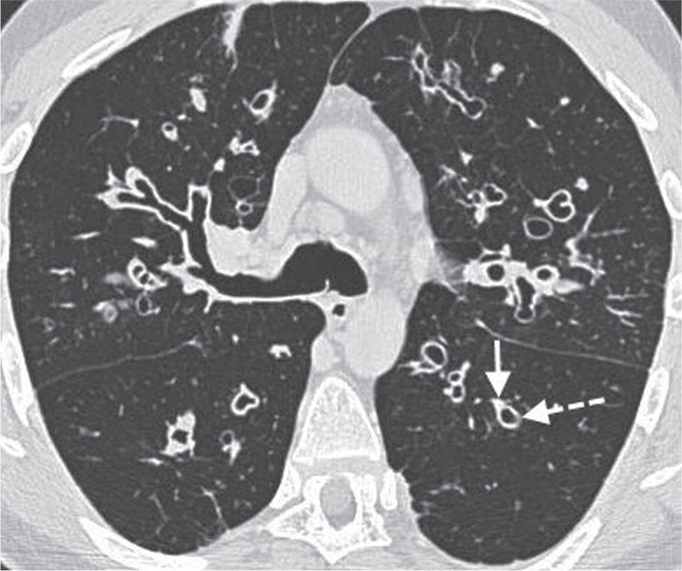 Commonly encountered chest/lung CT scan signs and their relevance