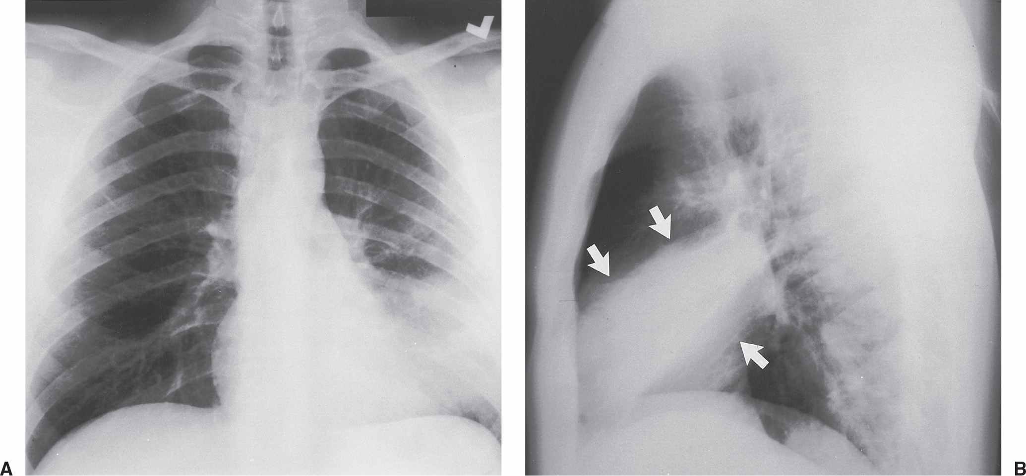 Golden S-sign (lung lobe collapse) | Radiology Reference Article |  Radiopaedia.org