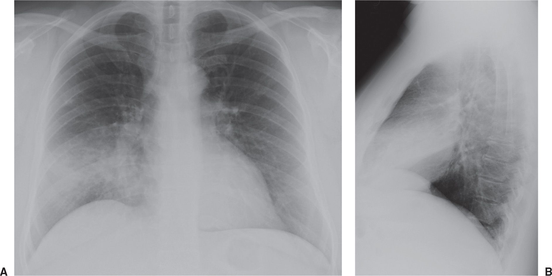Cystic fibrosis (pulmonary manifestations) | Radiology Reference Article |  Radiopaedia.org