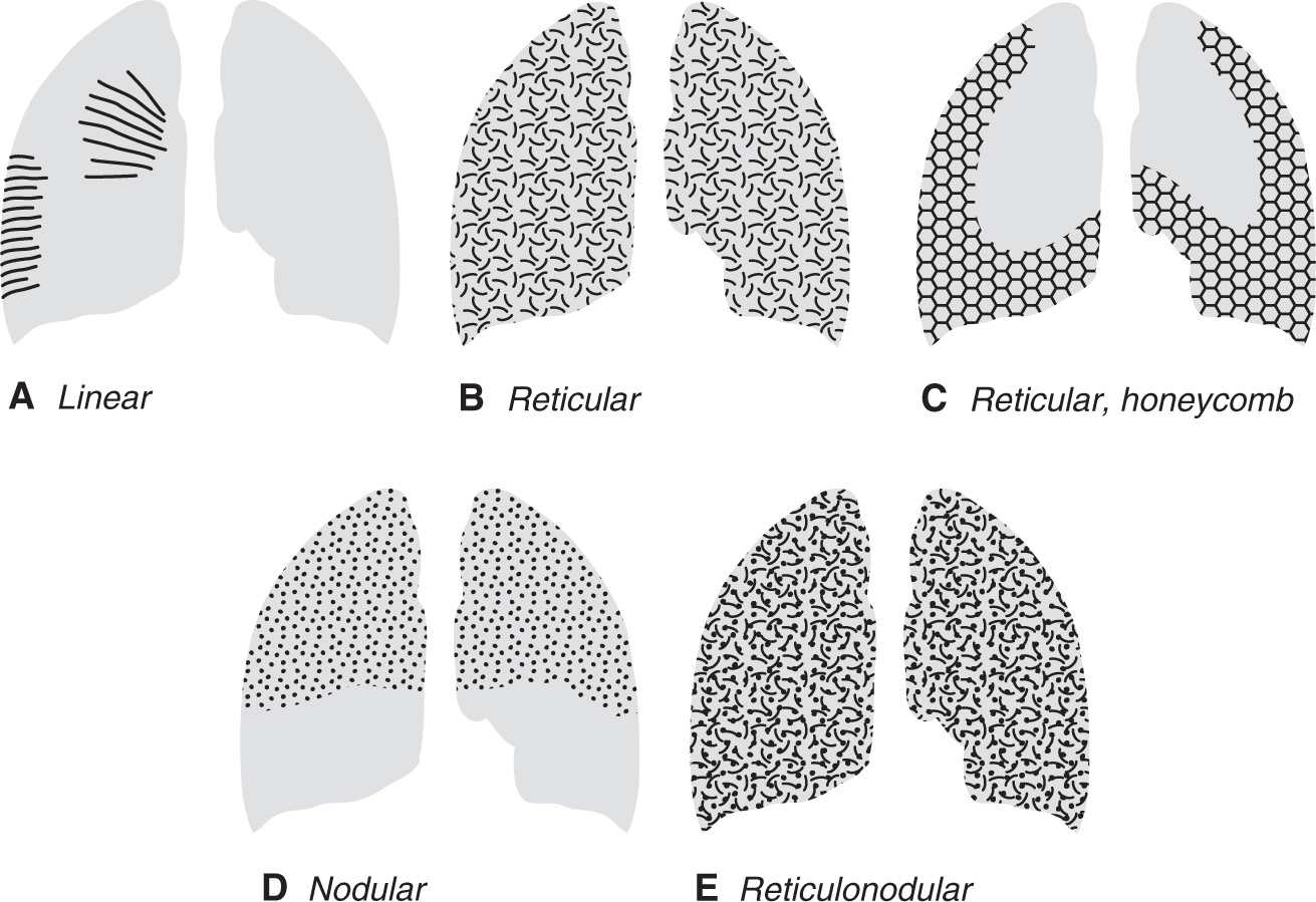 Interstitial Lung Disease Honeycombing