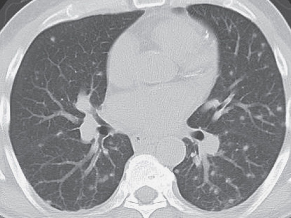 lung disease aging dead space