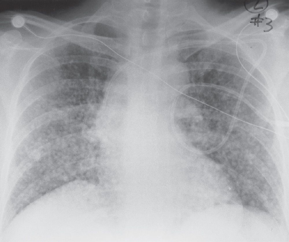 interstitial pneumonia x ray