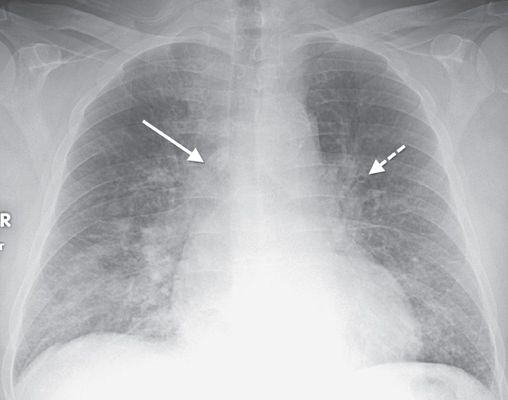 interstitial pneumonia x ray