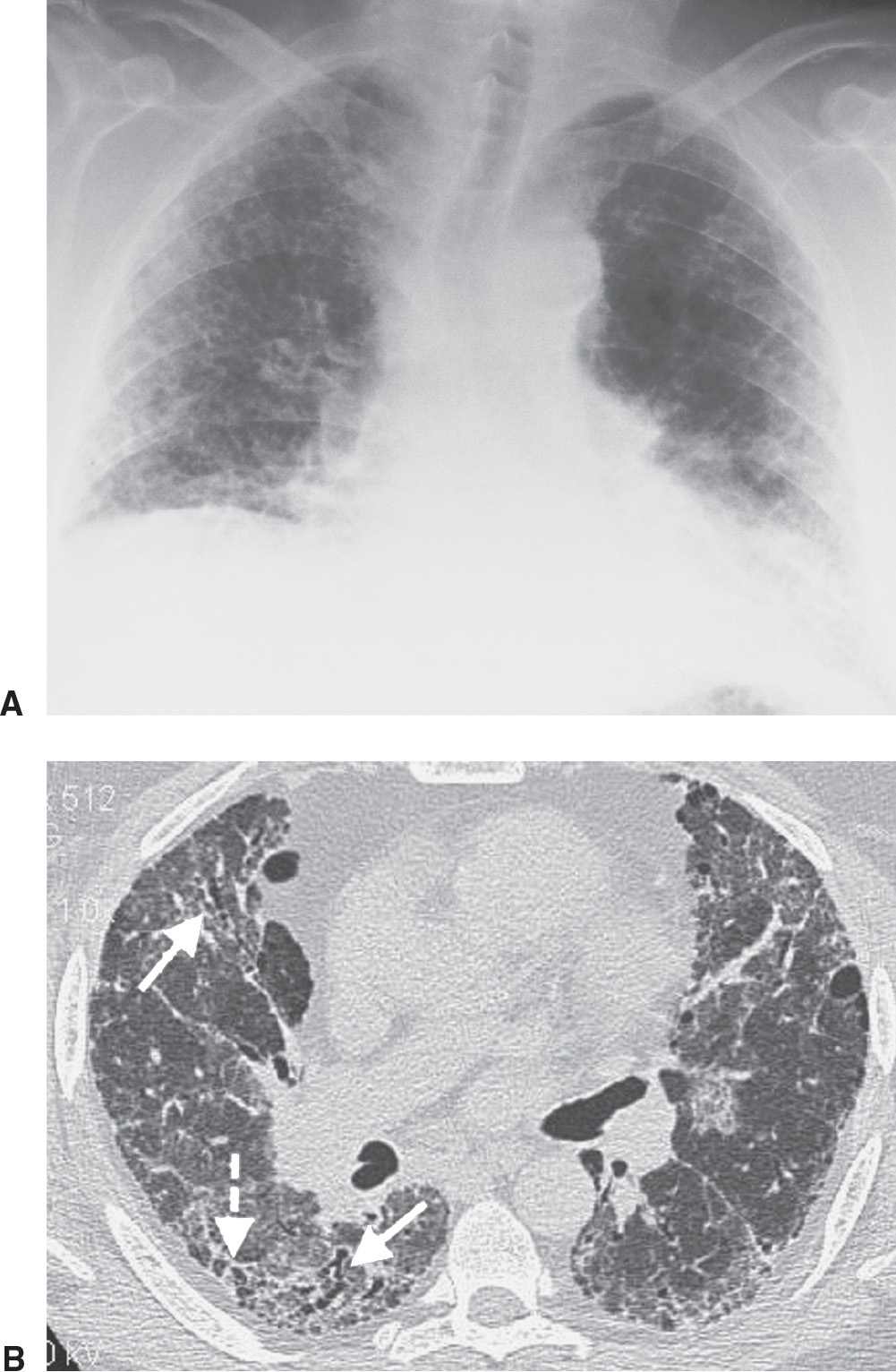 interstitial lung disease honeycombing