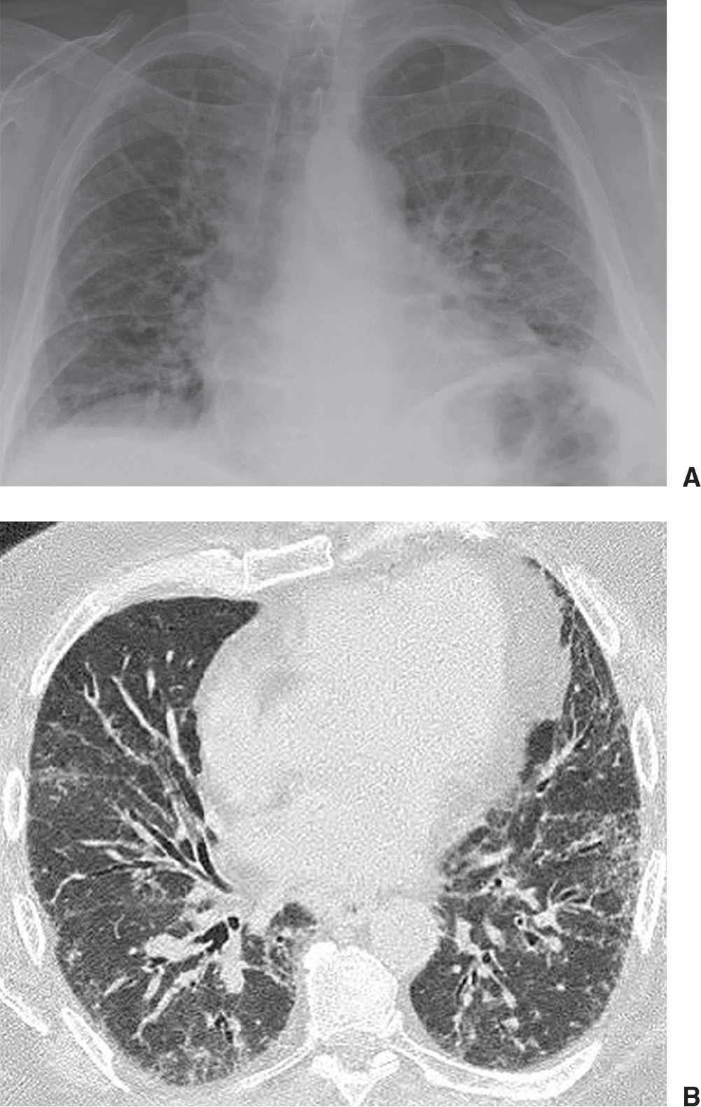 Interstitial Lung Disease X Ray