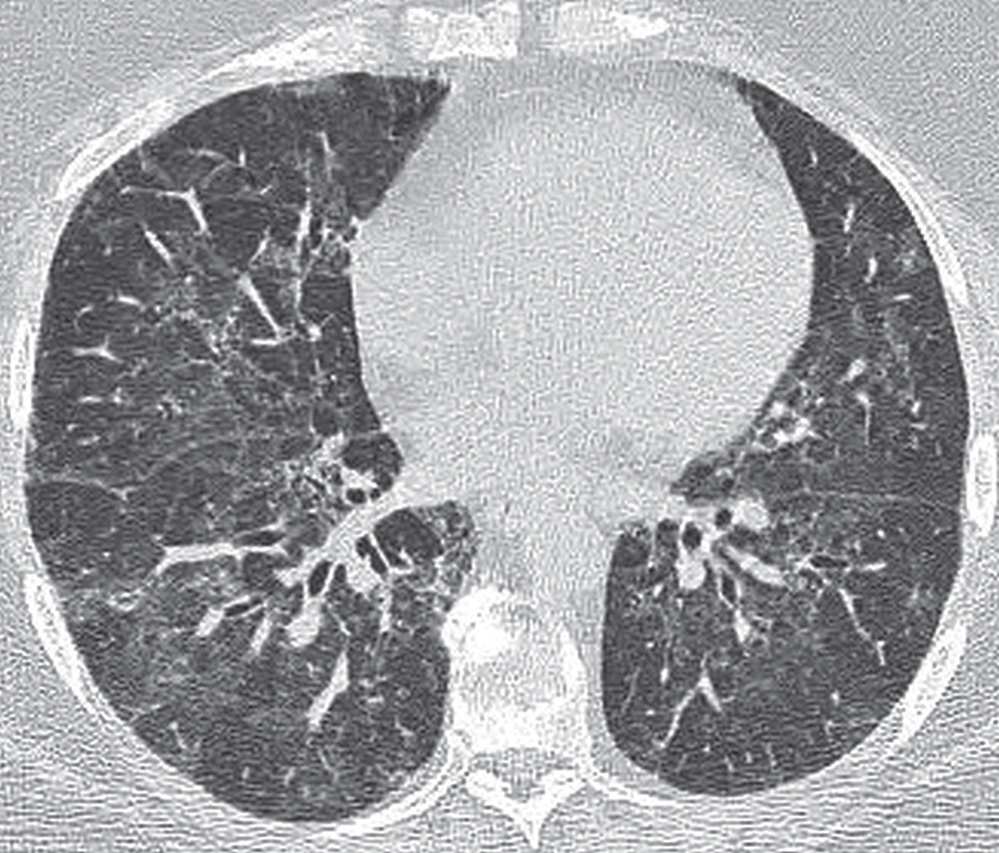 Interstitial Lung Disease Ct Scan