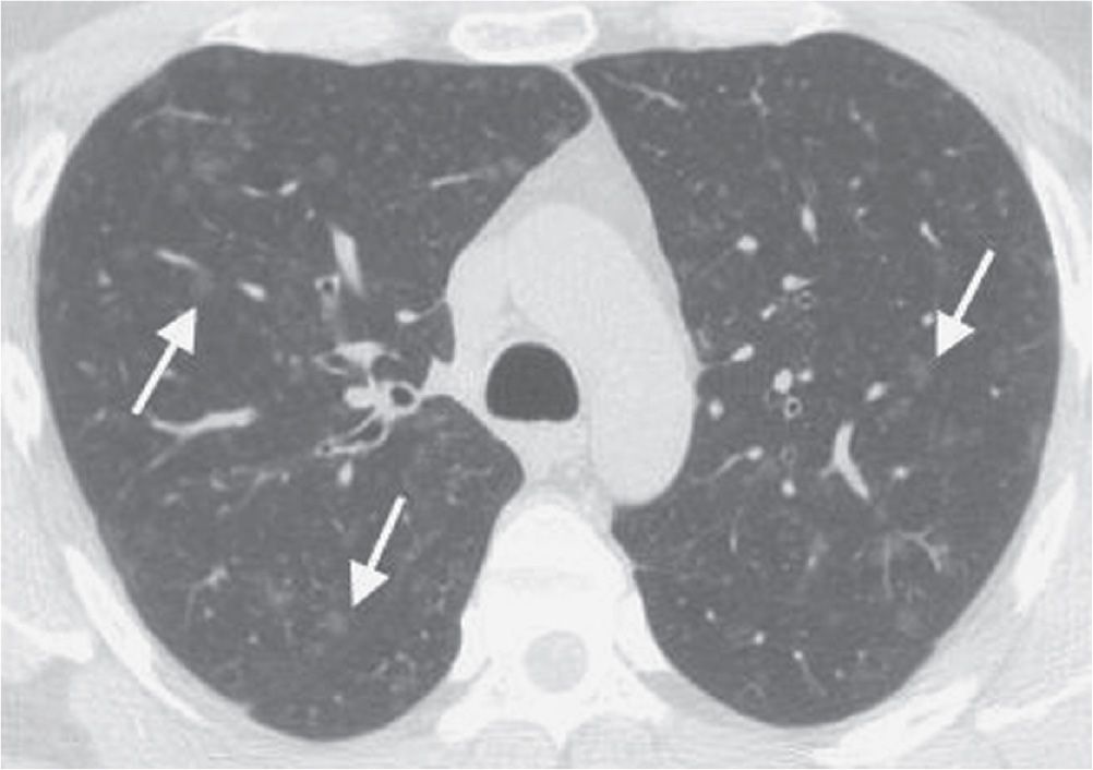 Ground Glass Lung Disease - Asthma Lung Disease