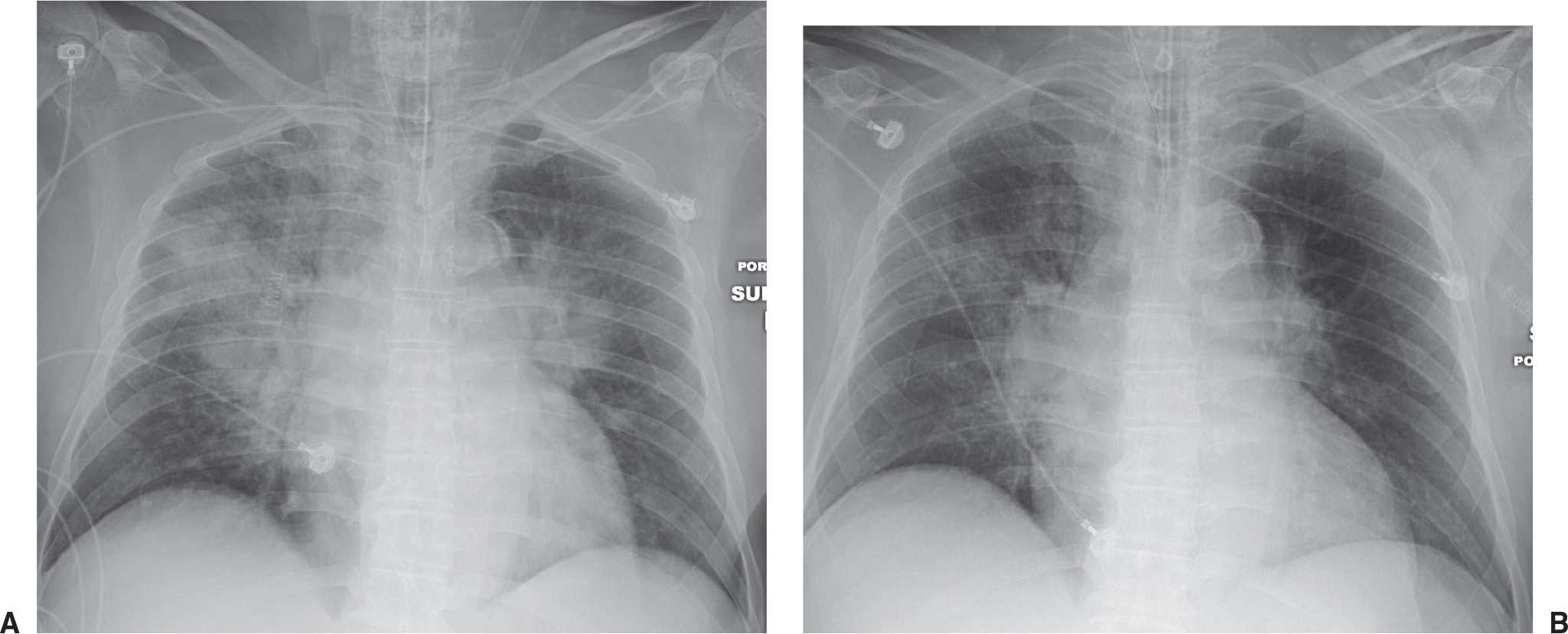 Alveolar Lung Disease Radiology Key