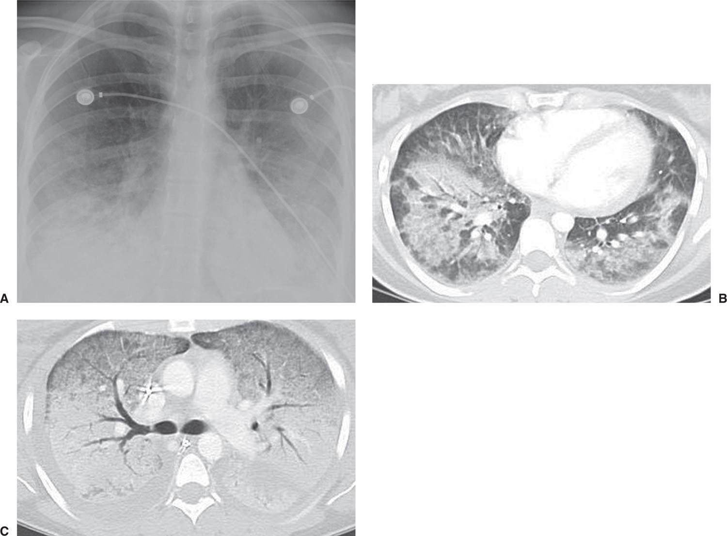 Alveolar Lung Disease Radiology Key