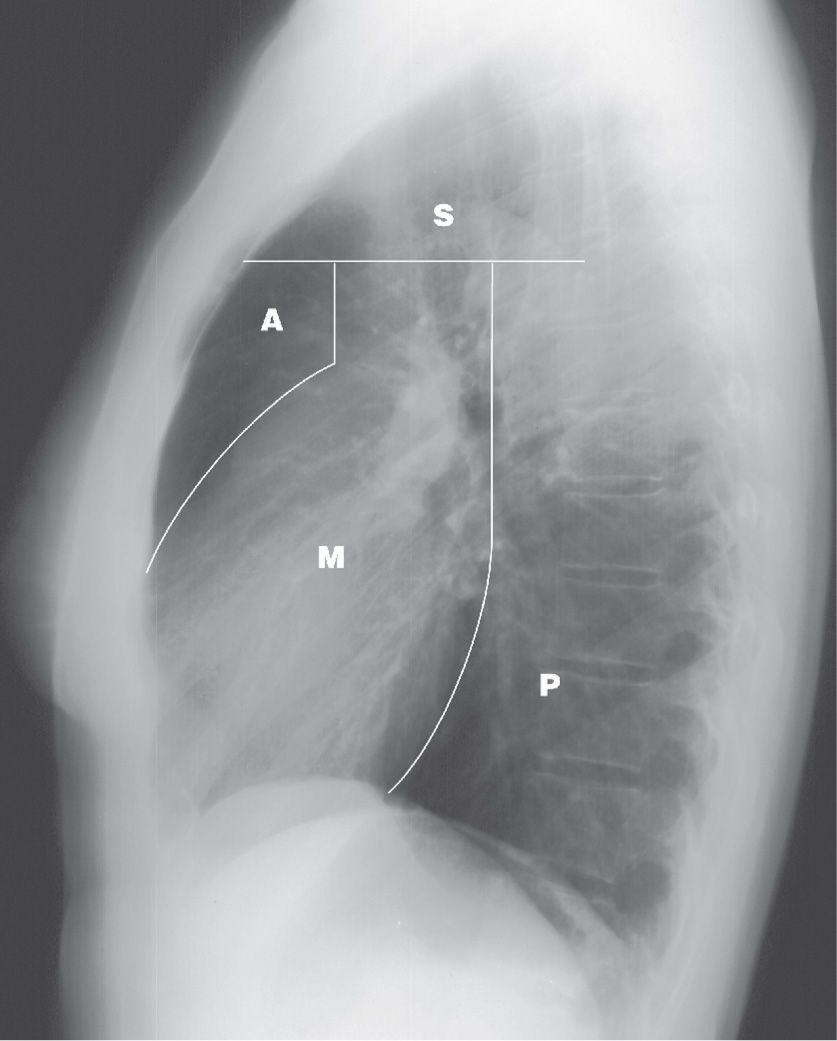 mediastinum-chest-x-ray