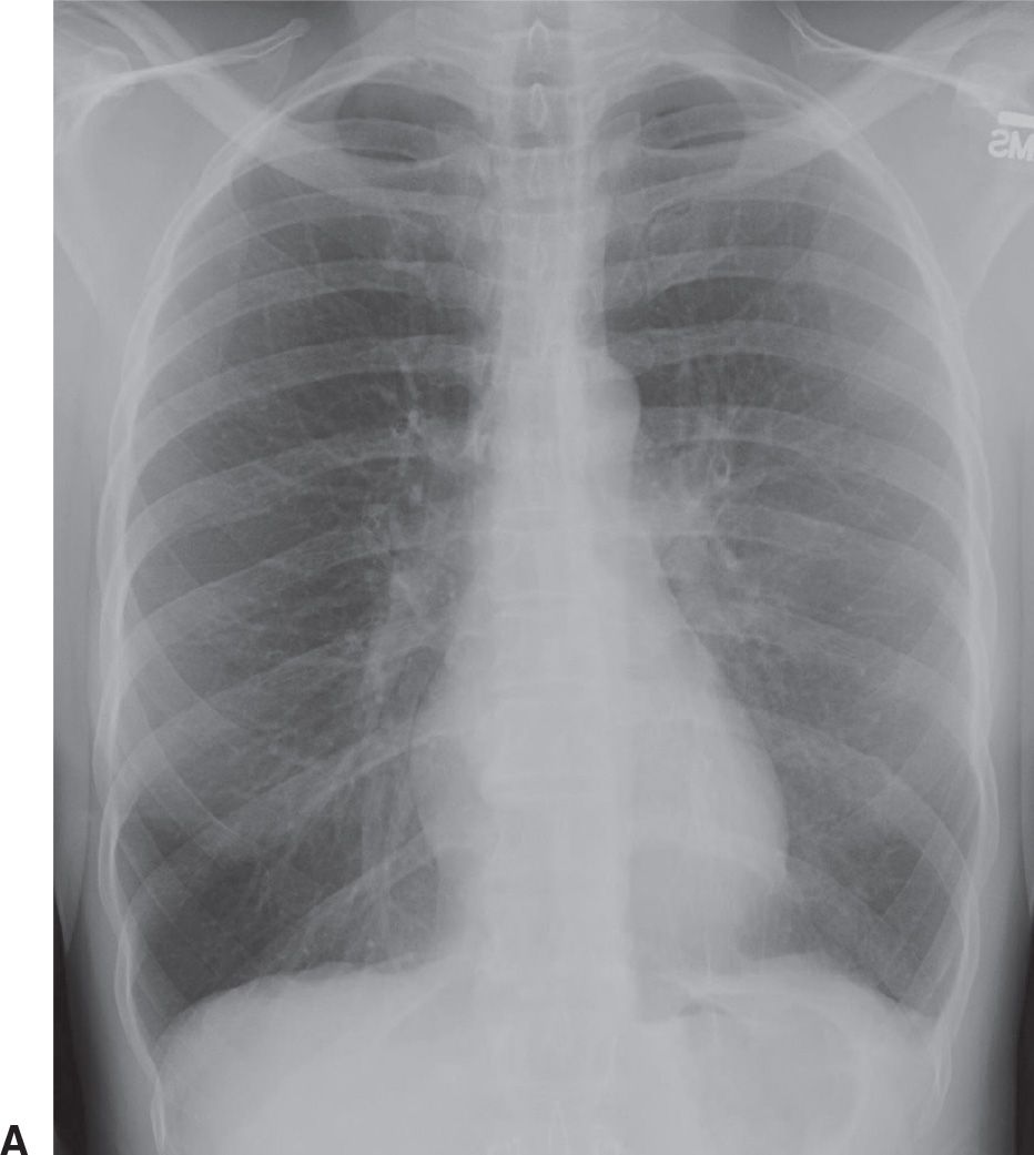 clinical-approach-to-childhood-mediastinal-tumors-and-management