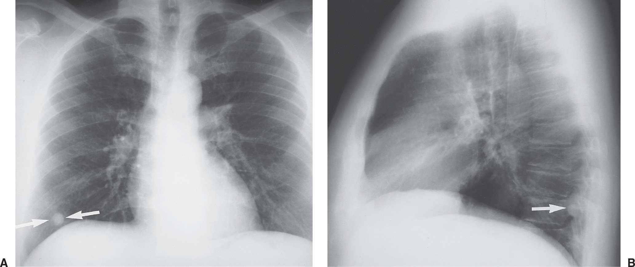 Pulmonary Nodules Radiology