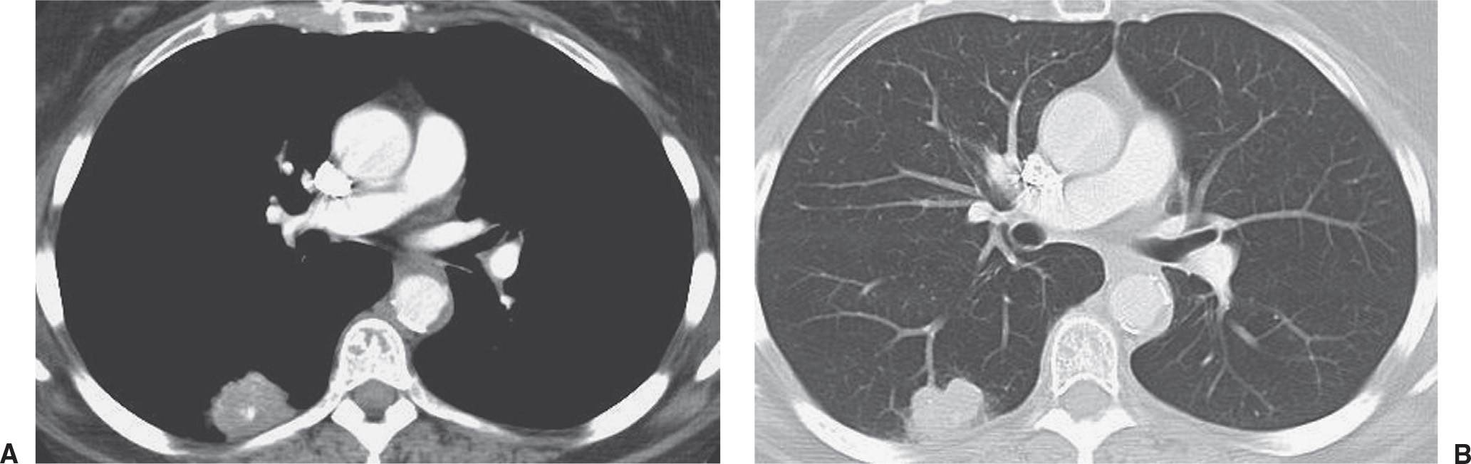 calcified lung adenocarcinoma ct