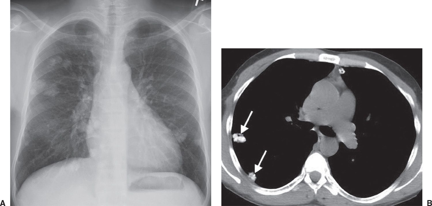  multiple lung nodules