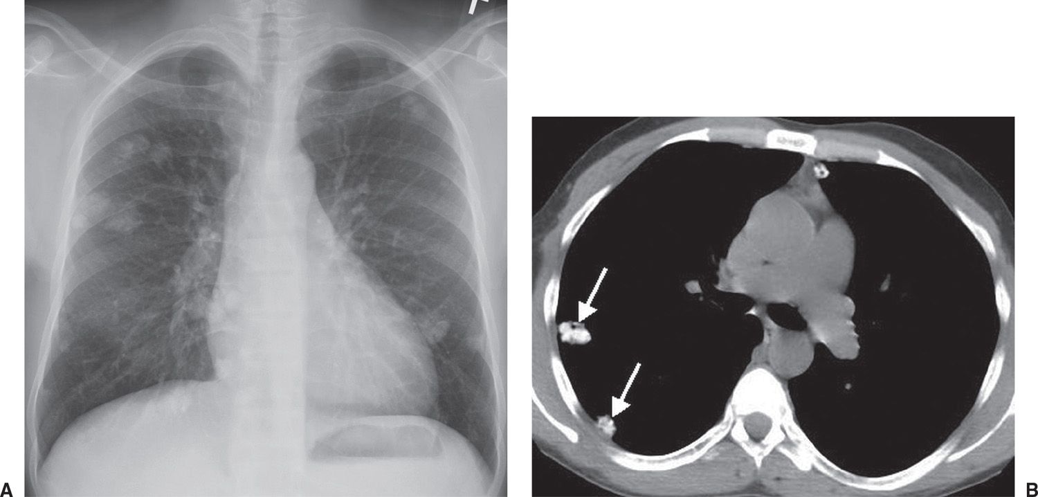 Calcified Lung Adenocarcinoma Ct