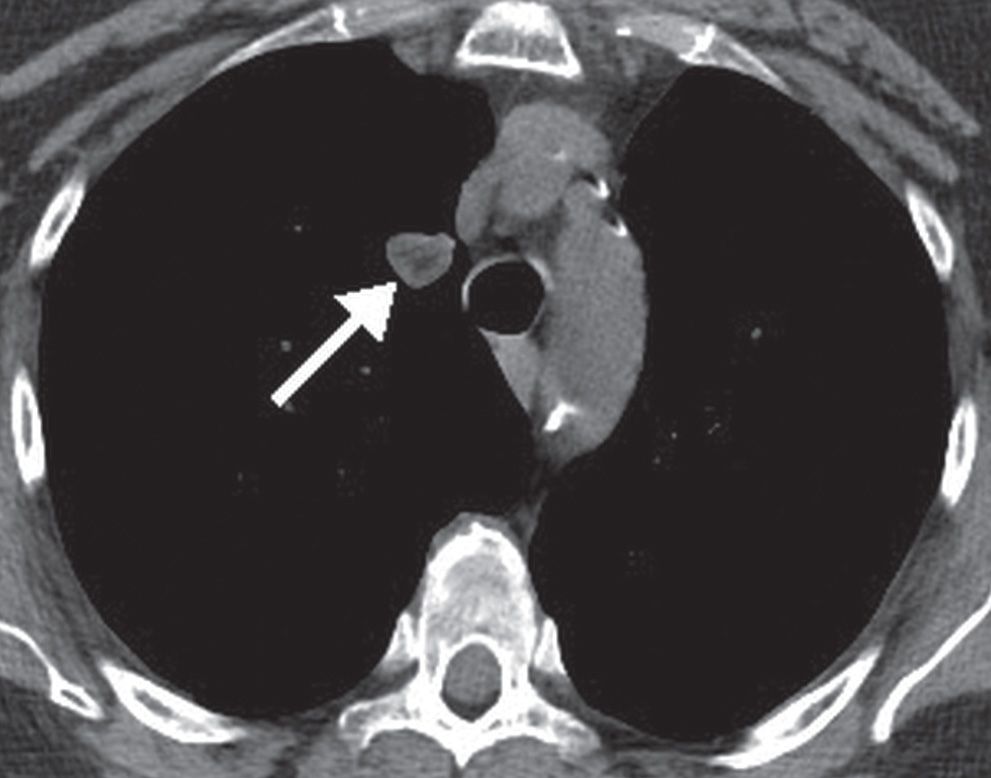 lobe pulmonary nodule