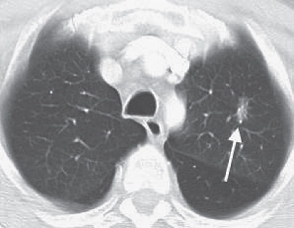 What Do Lung Nodules Look Like On Ct Scan Ct Scan Machine